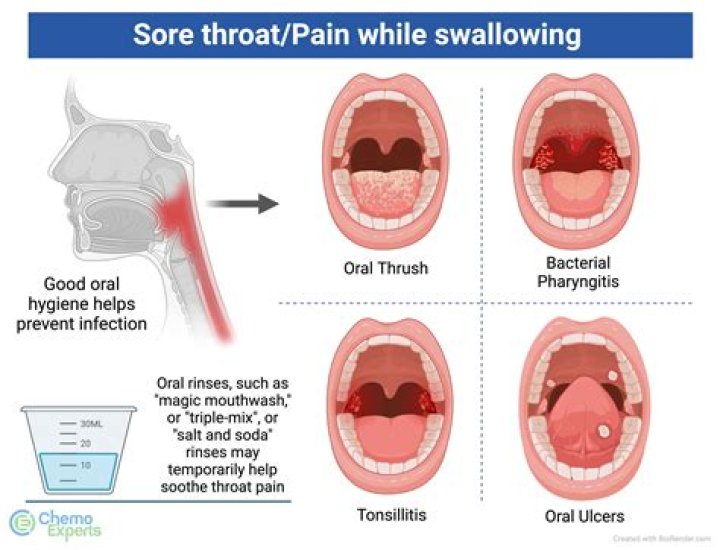 Does Sprite Hold The Cure For Sore Throats?