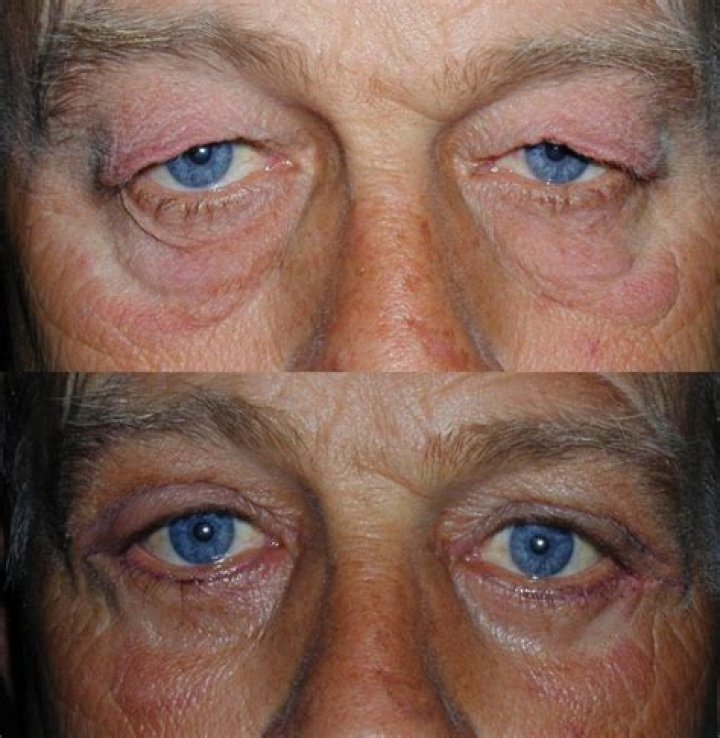 Unveiling The Allure: Celebrities With Droopy Eyes