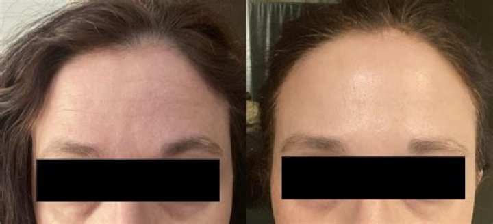 Unveiling The Risks And Realities: Can Botox Go Wrong?